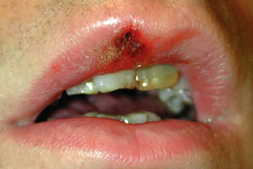 Primary Syphilis